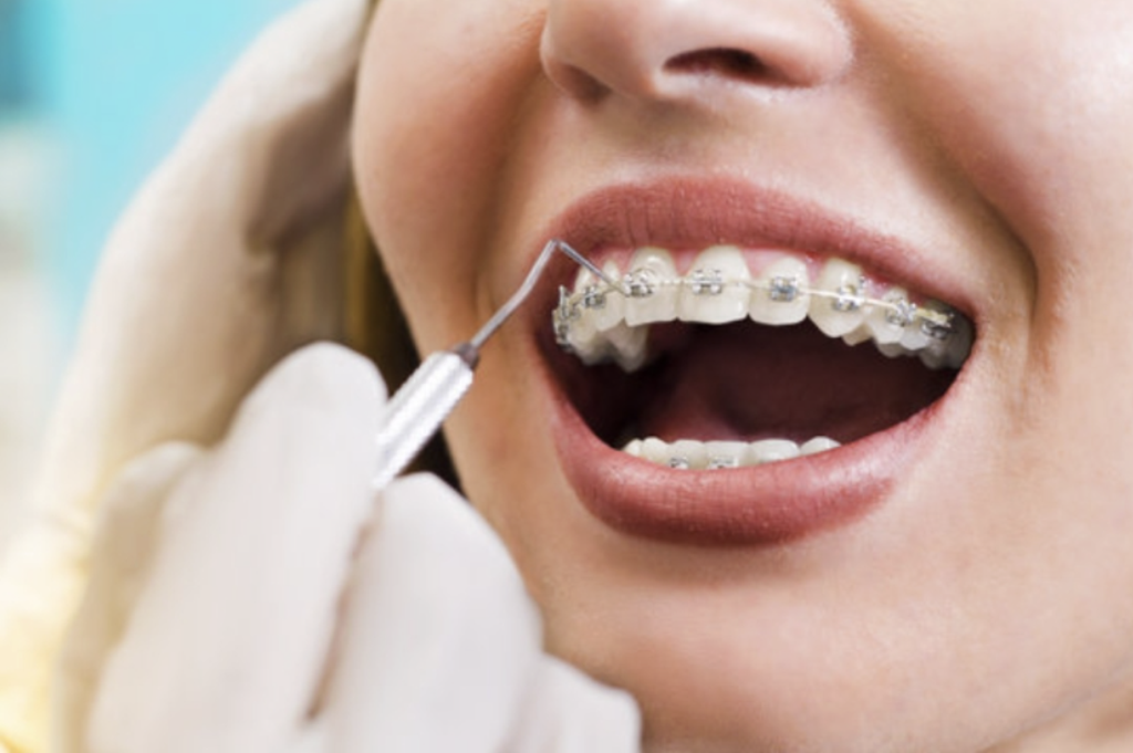 Fixed braces treatment at Bay Dental Brighton