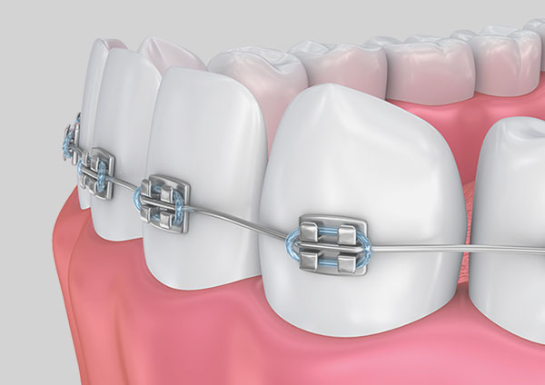 Orthodontic braces and clear aligners at Bay Dental Brighton